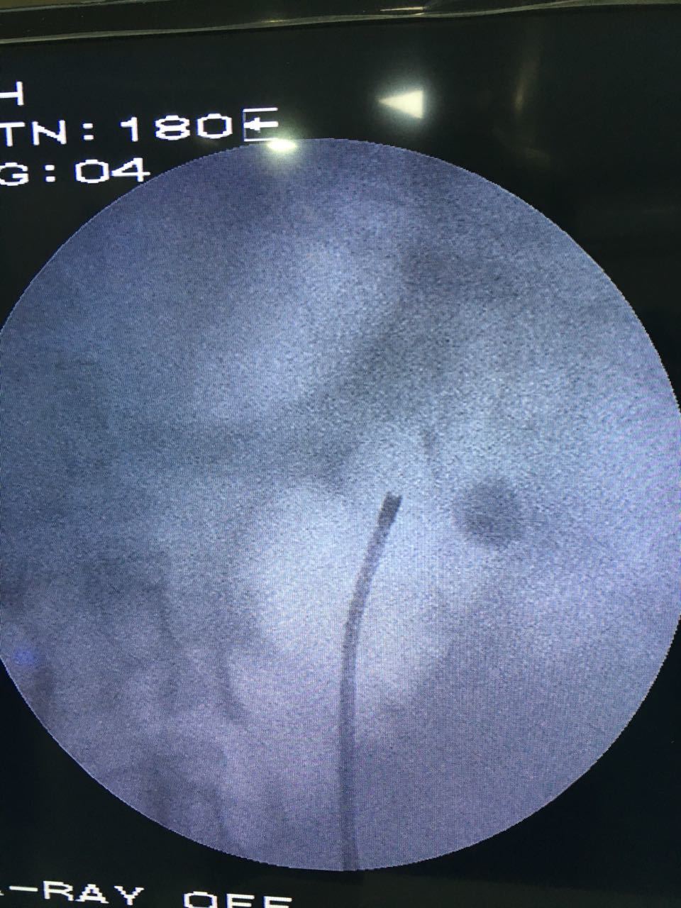 Flexible Ureteroscopy using high watt LASER for large burden kidney stone