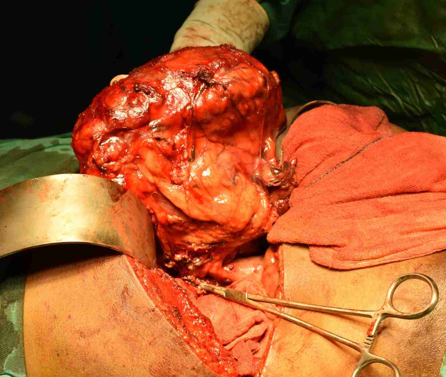 Kidney Cancer treated by Open Nephrectomy
