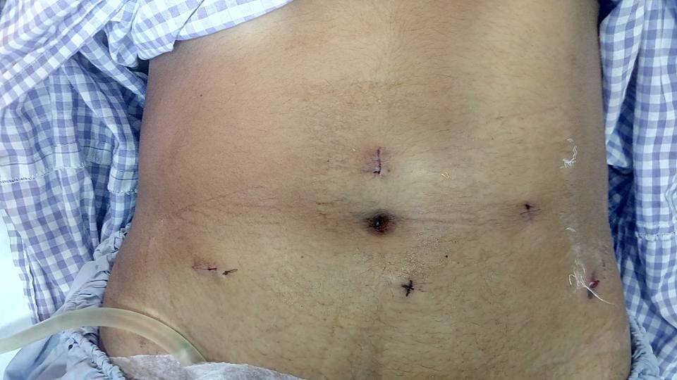 * Ectopic Pelvic kidney with Pelvi-ureteric junction obstruction