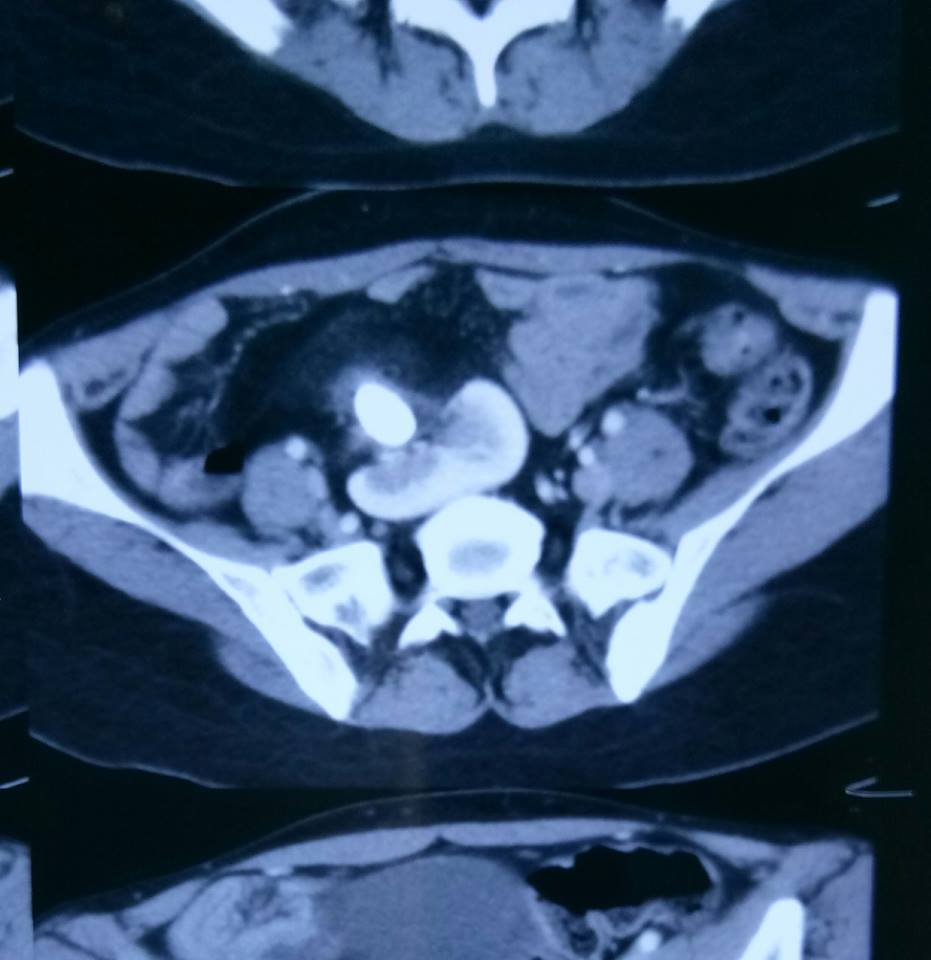 *Ectopic Pelvic Kidney with pelvic stone